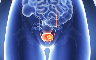 膀胱がんについての知識