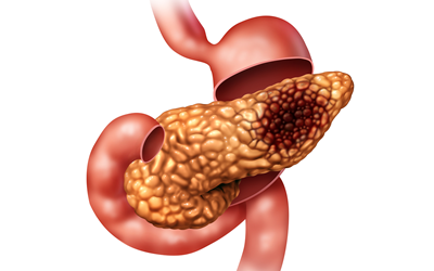 膵臓癌の患者の症状